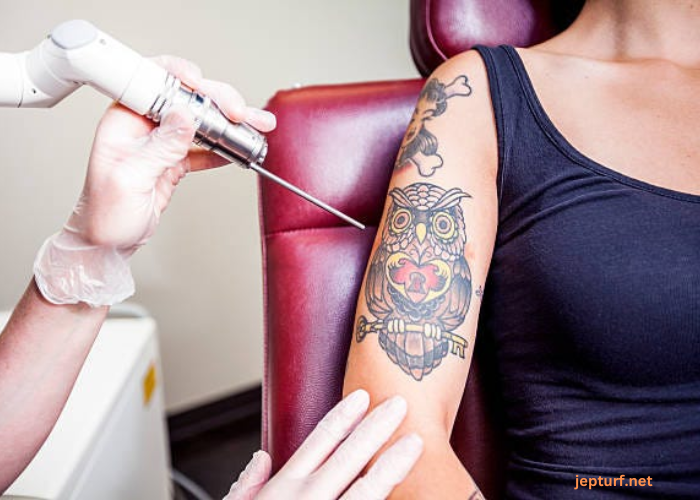 An Ultimate Guide to Safe and Effective Tattoo Removal